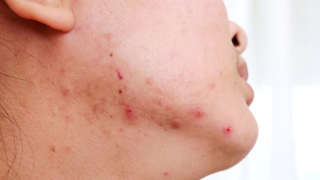 pcos acne