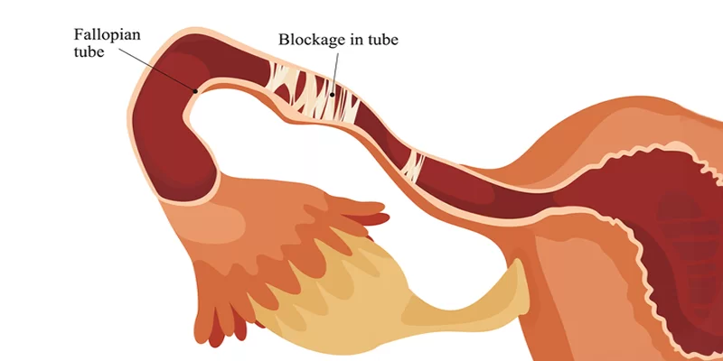 blocked fallopian tubes